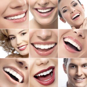 סוגי ציפויים לשיניים